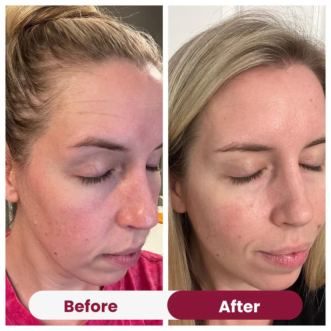 Wrinkle Forehead Patch - Image 6